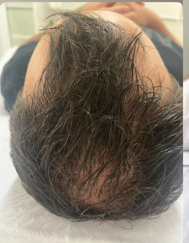 Couro cabeludo antes do tratamento capilar, com rarefação na região central