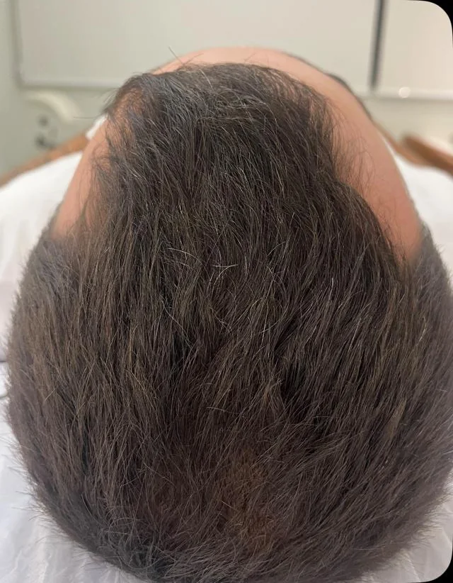 Couro cabeludo depois do tratamento capilar, com densidade recuperada